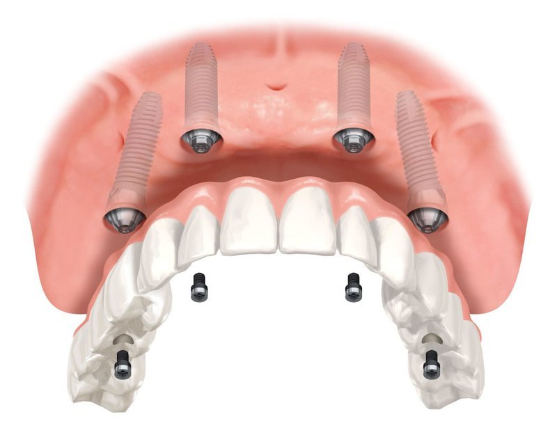 All-on-4 implant-supported dentures illustration (four implants supporting a full arch)