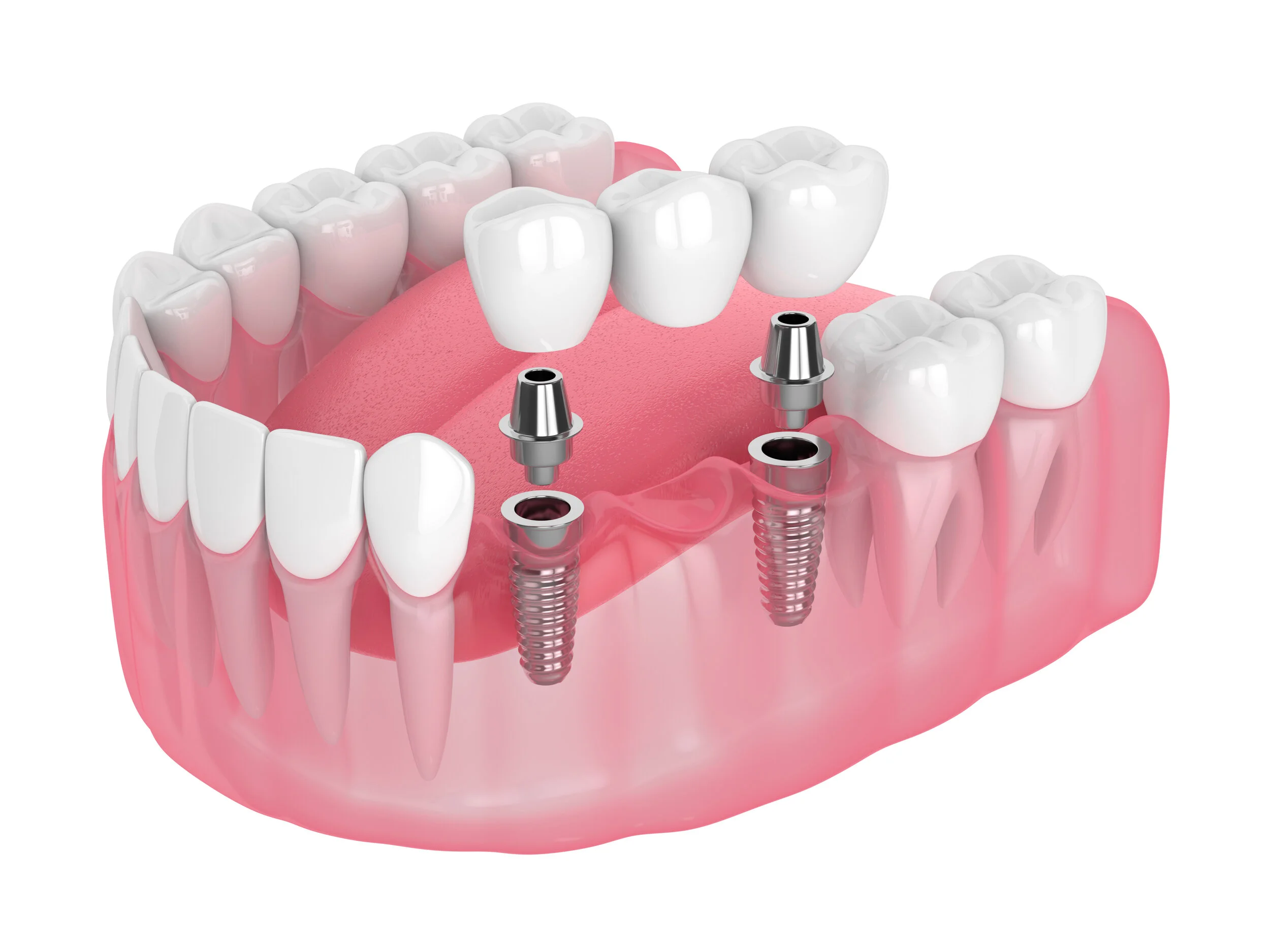 Illustration of multiple missing teeth replaced with an implant-supported bridge