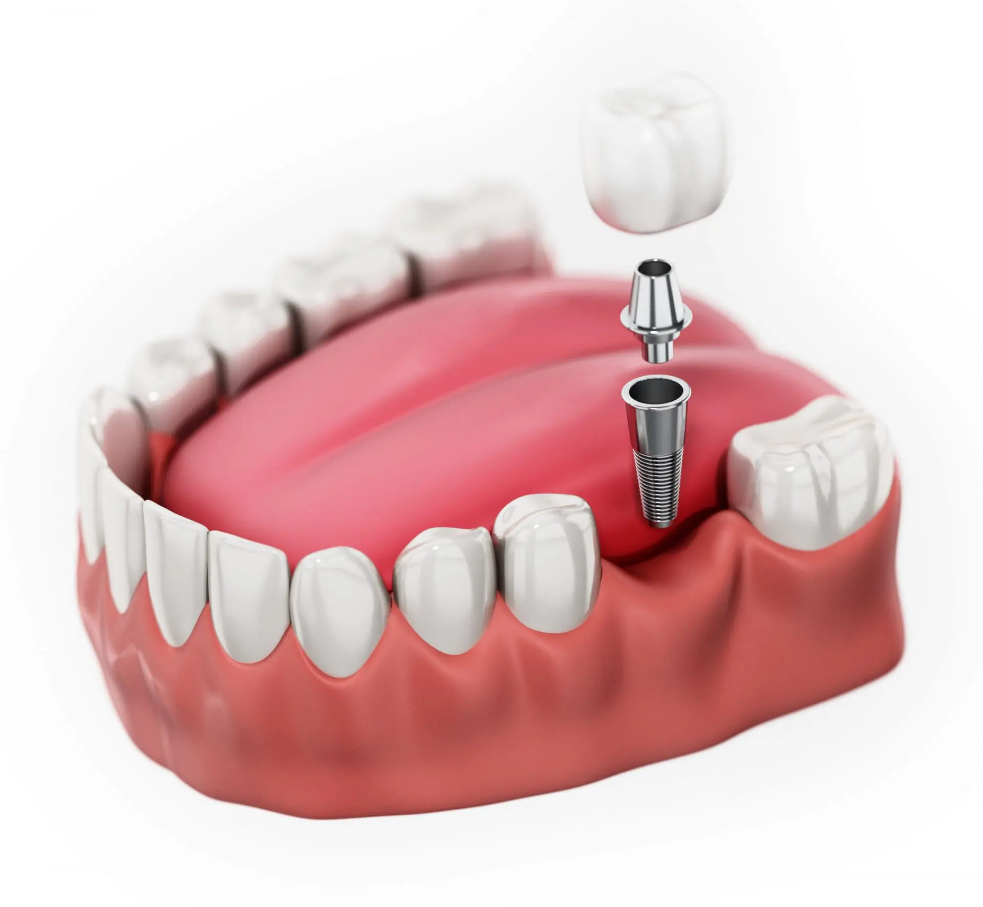 Illustration of a single tooth dental implant with a crown on top